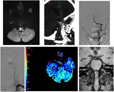 Case report: Medulla oblongata and cervical cord reperfusion injury after intracranial vertebral artery angioplasty and stenting